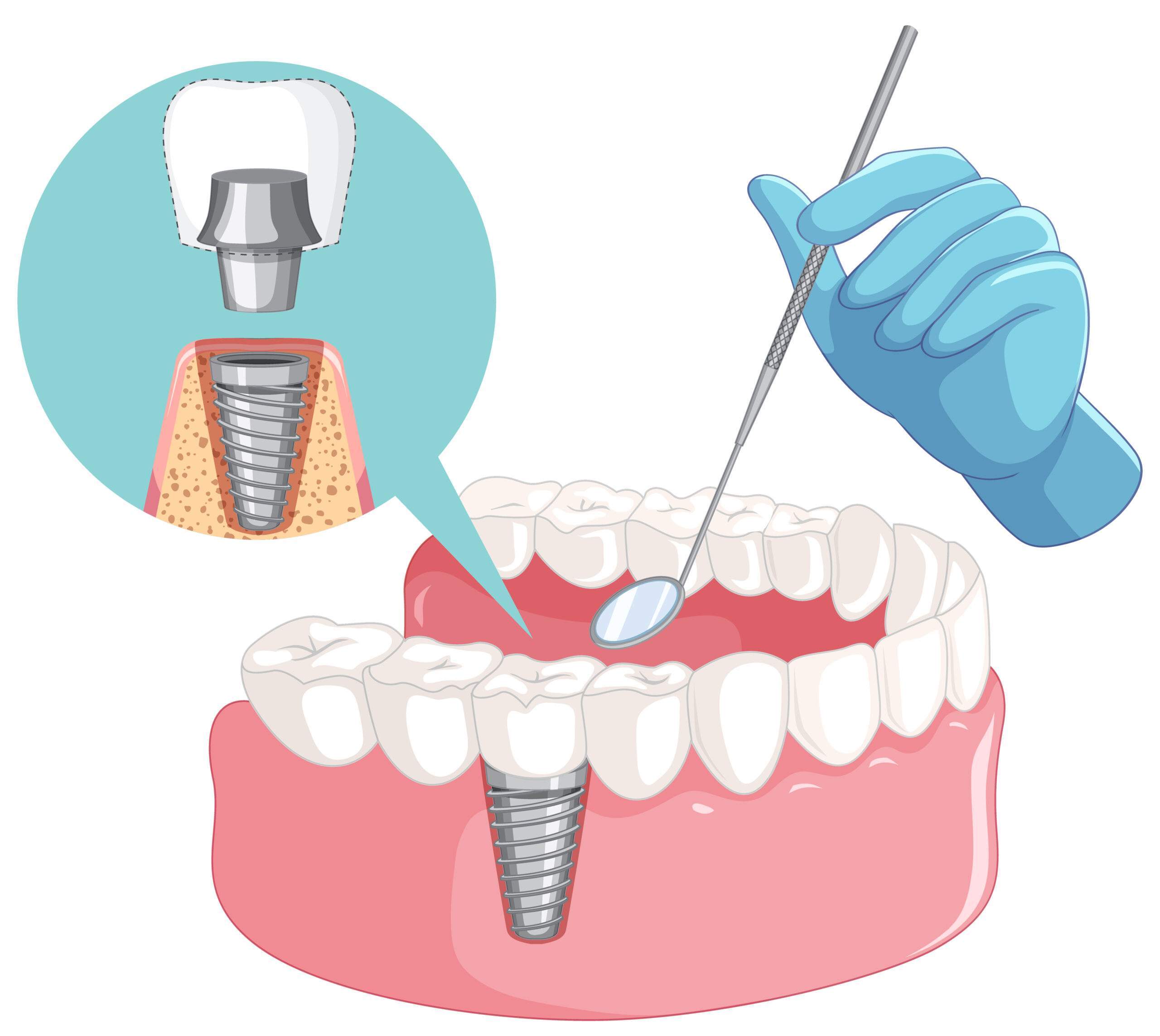 Implantes dentales con facilidad de pago en Mirasierra